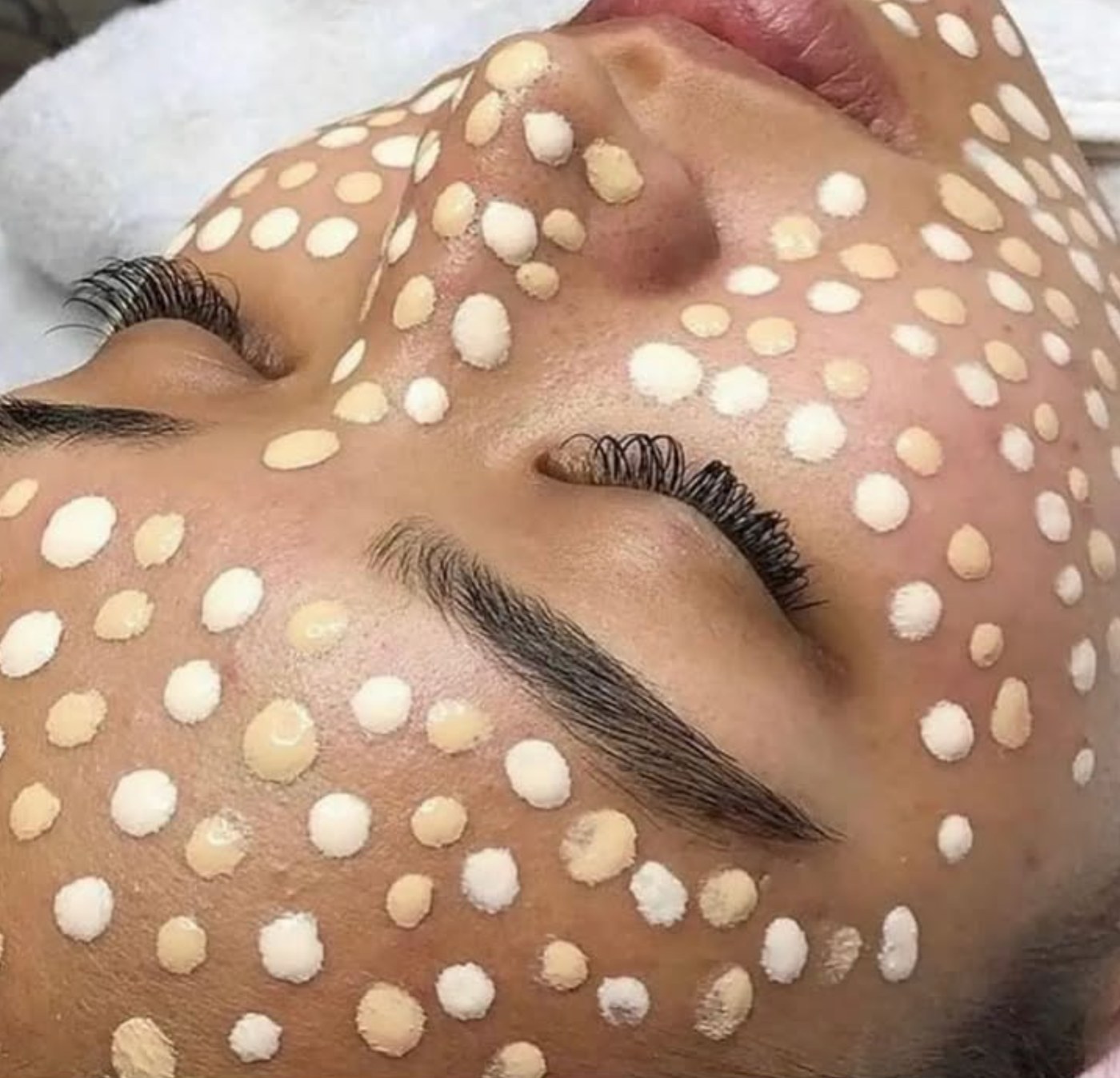 Tratamento para acne